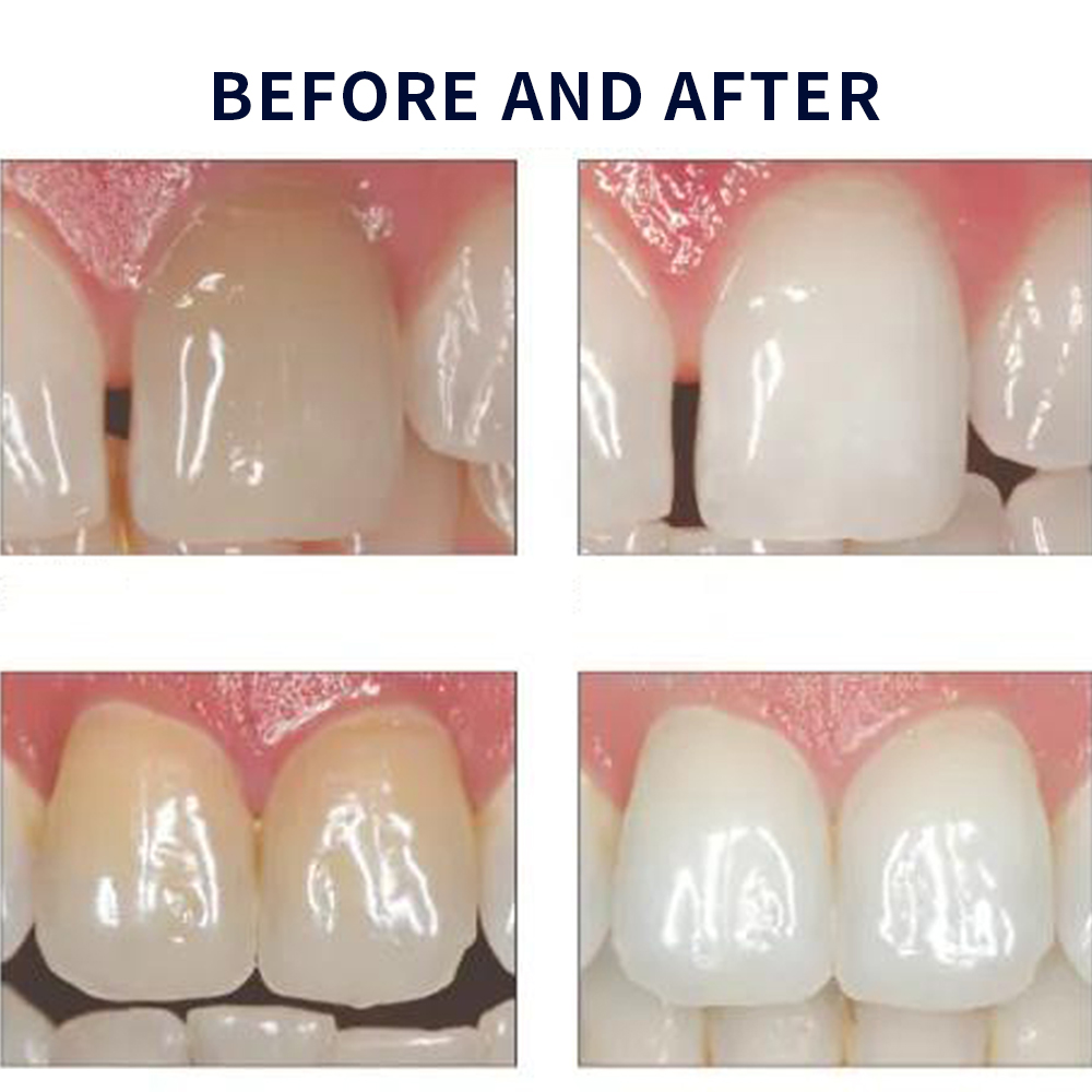 Opalescence Whitening 20% PF 2 - Teeth Whitening Hydrogen Peroxide avis et prix