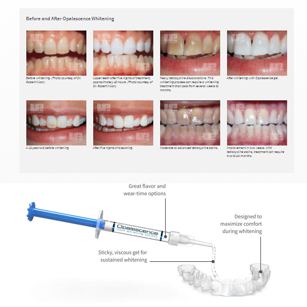 Opalescence Whitening 20% PF 2 - Teeth Whitening Hydrogen Peroxide avis et prix