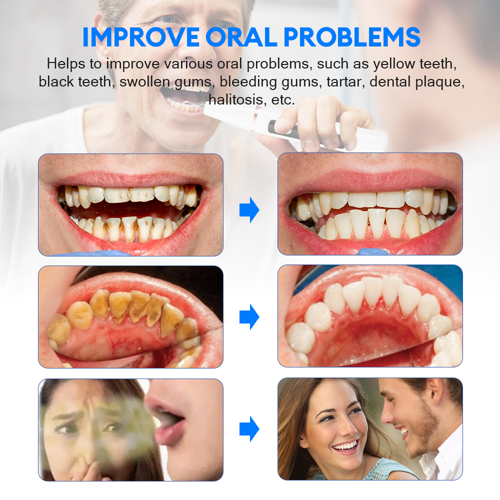 Electric Ultrasonic Dental Sca - Teeth Whitening Mouthwash avis et prix
