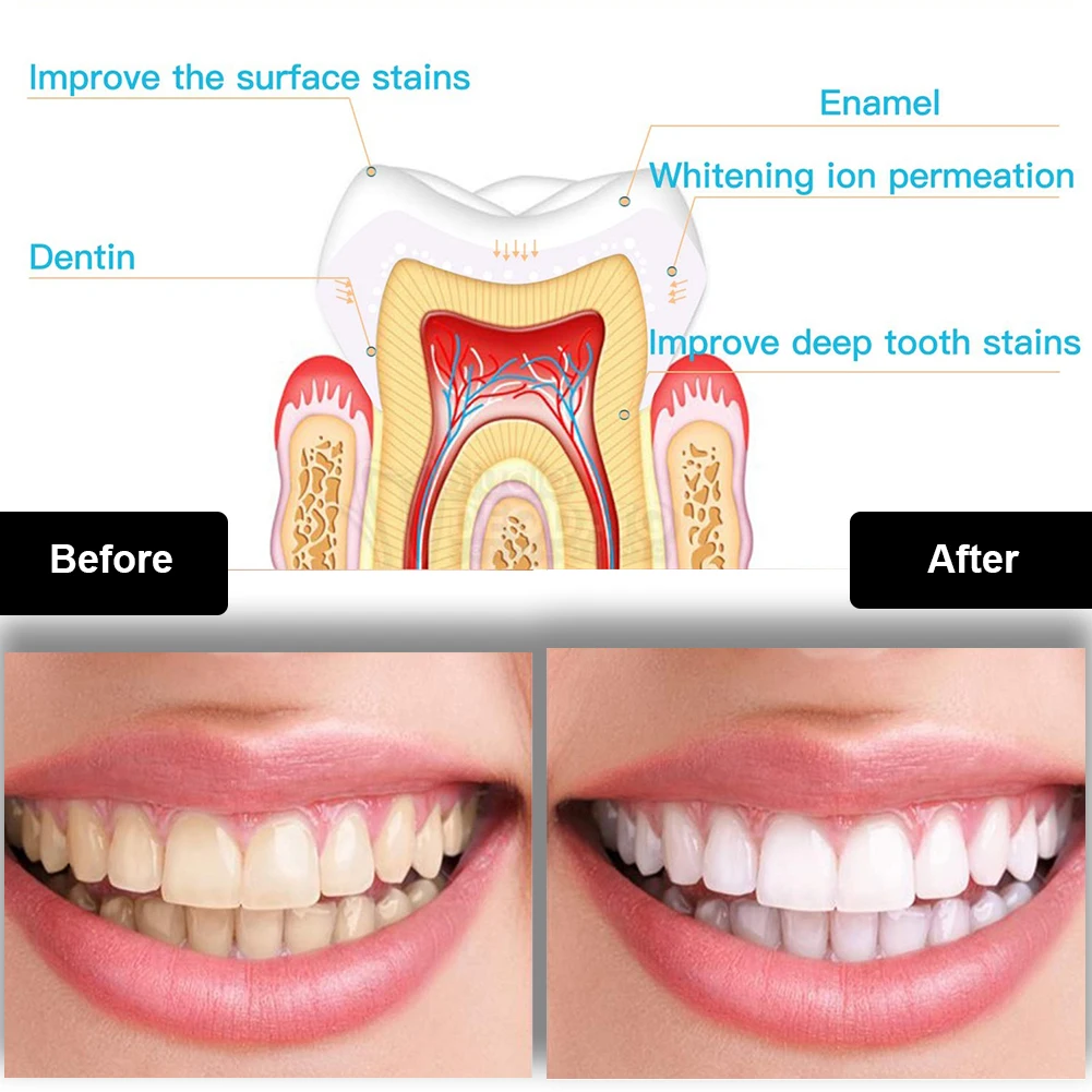 Dental Teeth Whitening Kit Min - Teeth Whitening Price avis et prix