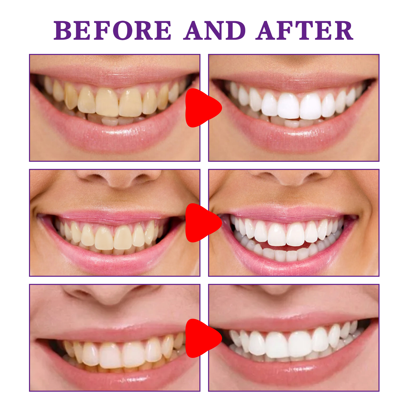 Teeth Cleansing Whitening Toot - Teeth Whitening In Korea avis et prix