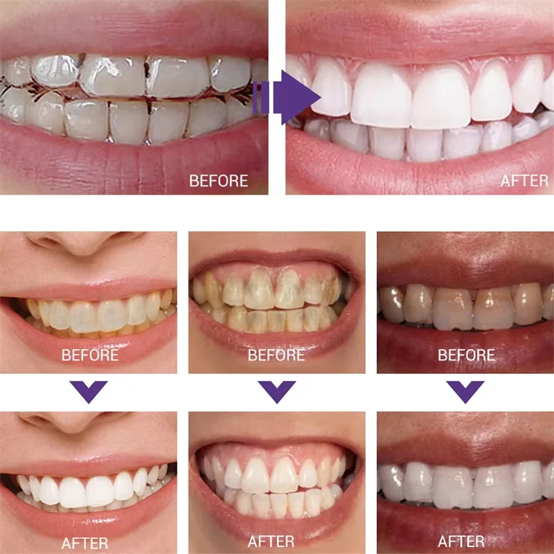 Whitening Toothpaste Teeth Cle - Teeth Whitening In Korea avis et prix